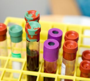 10 vials of blood in a yellow tray